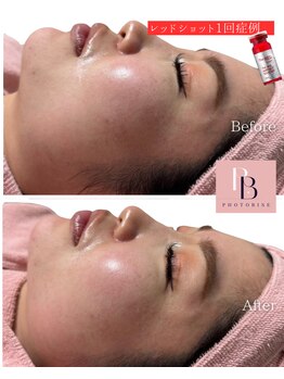 フォトビズ/レッドショットで二重顎解消！