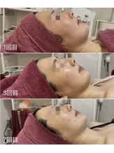 GRACETHOUSAND(グレイスサウザンド)/ハーブピーリング/毛穴洗浄