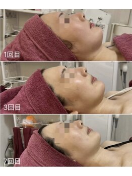 GRACETHOUSAND(グレイスサウザンド)/ハーブピーリング/毛穴洗浄