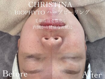 ルチーレ(Lucire)の写真/【剥けないハーブピーリング　初回7,700円】ターンオーバーを促し毛穴レスの韓国美肌へ