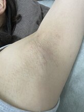 ナノハナ/鹿沼市の全身脱毛のナノハナ