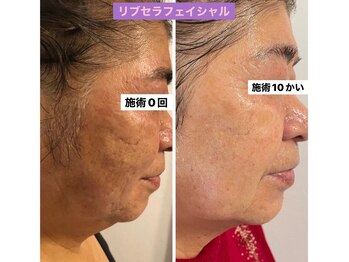 プリュネル(Prunelle)/プラズマシャワー