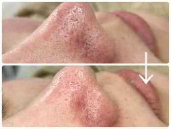 ニコ(Nico)/毛穴エクストラクション