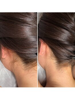 インベスト(INVEST)/うなじ脱毛