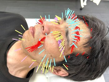 とだ鍼灸院の写真/『倦怠感/毎朝起きられない/痛い!』5年以上の辛い症状も早期改善◎頑固なクマも解消！美容鍼100本が大人気*