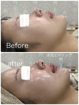 ルミネル 名古屋新栄(Luminelle)/水光ピーリング