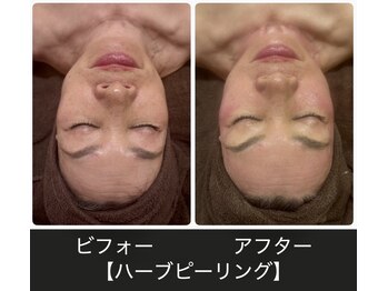 ジェイアンドエス(J&S)/ハーブピーリング