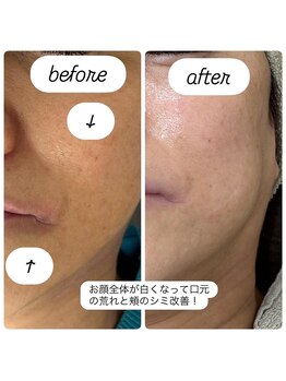 ラサンテ(Le Sante)/*マツヤニホットセラピー*