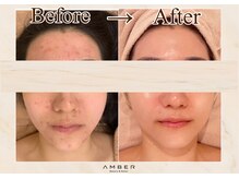 アンバー 恵比寿(AMBER)の雰囲気（【都内希少◎顔含め全身のハーブピーリング♪】　）