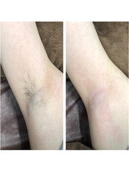 ハレノヒ(HaLeNoHi)/【ブラジリアンワックス】