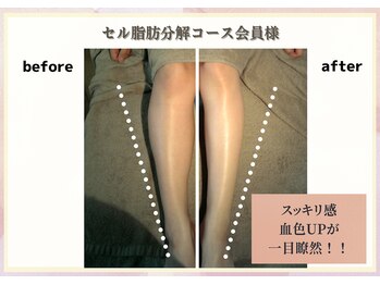 ビューティースリム リボーン 吉祥寺店(reborn)/【スーパーセルム】1回の変化！