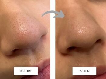 リンネ(Rin'ne)/【1回の効果】毛穴洗浄