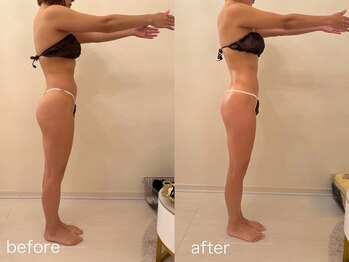 クロレ 浦和店(CLORE)/30代のお客様/5回施術