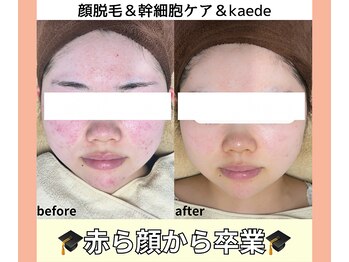ベルミーランド 浜松天王/フェイシャルBefore→After