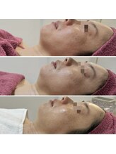 GRACETHOUSAND(グレイスサウザンド)/ハーブピーリング/毛穴洗浄