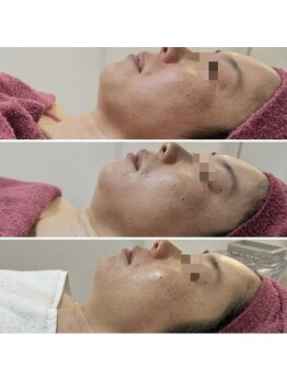 GRACETHOUSAND(グレイスサウザンド)/ハーブピーリング/毛穴洗浄