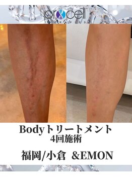 アンドエモン(&EMON)/【ボディ】プロセル効果