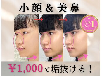 ラプリ 梅田店(Raplit)/隆鼻+輪郭矯正40分30回