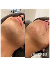 エクラ(eclat)/メンズひげ脱毛