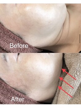 コウベ美容鍼灸治療院(KOBE美容鍼灸治療院)/たるみ改善３フェイスライン施術