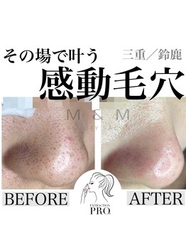 エムアンドエム(M&M)/毛穴改善コース