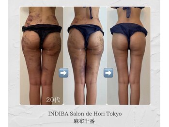 インディバホリトウキョウ(INDIBA HORI TOKYO)/世界唯一無二のINDIBAメソッド!