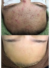 モモンウールー/最新/ハーブピーリング