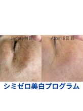 エリア(area.)/11、【シミケア35分】