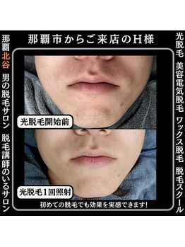 ディースタイル 北谷店(Dstyle)/北谷メンズ脱毛ヒゲBefore After