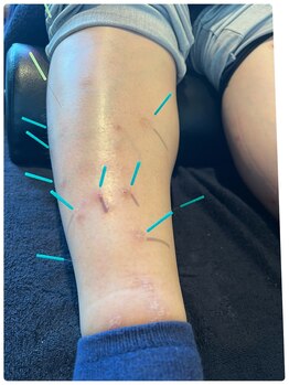 メディカルジャパン 吉祥寺/皮膚症状に対しても鍼は有効です