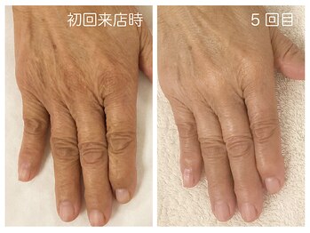 キレイテ 福岡天神店/60代/5回目【福岡ハンドケア】