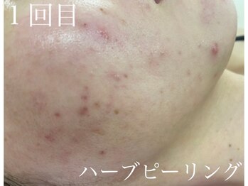 チャーム(Charm)/ハーブピーリング