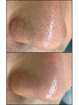 ビューティーグロウ(BEAUTY-GROW)/メンズ　毛穴ケア