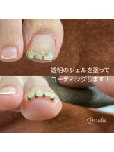 ル ソレイユ(Le soleil)/巻爪矯正【まきづめリフト使用】