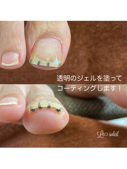 ル ソレイユ(Le soleil)/巻爪矯正【まきづめリフト使用】