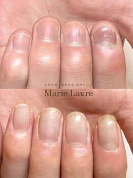 マリーロール 淀屋橋本店(Marie Laure)/自爪育成/深爪矯正/ネイルケア