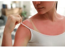 リサ(LiSA)/Q.日焼け後は脱毛できますか？