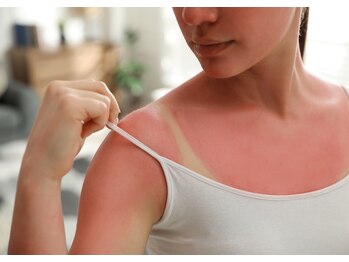 リサ(LiSA)/Q.日焼け後は脱毛できますか?