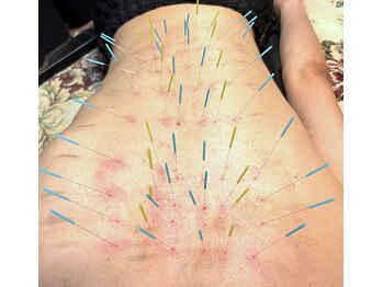 とだ鍼灸院/背中・腰痛・自律神経症状に