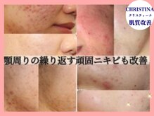 ハイフン(HIFUN)の雰囲気（大人気の毛穴洗浄やピーリングで最短ルートで美肌へ導きます☆）