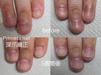 プリンセスネイル(Princess nail)/深爪矯正3週間の変化!