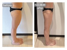 リラ(RILA)/キャビ+マッサージbefore after