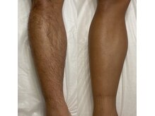 レヴール(reveur)/足脱毛[美容脱毛/新潟脱毛]