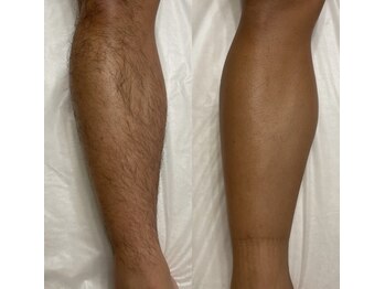 レヴール(reveur)/足脱毛[美容脱毛/新潟脱毛]