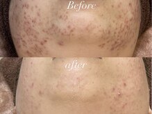 レシェルサロン(Lechelle Salon)/ハーブピーリング＋オプション