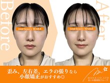 マイレ 甲賀水口店(MAILE)/小顔矯正（20代女性/施術1回目）