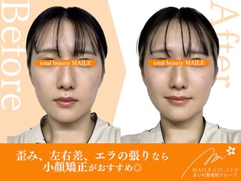 マイレ 甲賀水口店(MAILE)/小顔矯正(20代女性/施術1回目)