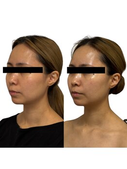 リノン(LIINON)/切らない。入れない。でも叶う