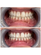 エクシアホワイトニング 日本橋店/ホワイトニング人形町