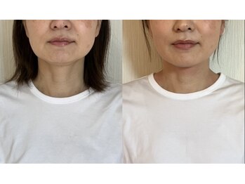 カラダミックス(karadamix)/頬のたるみ改善